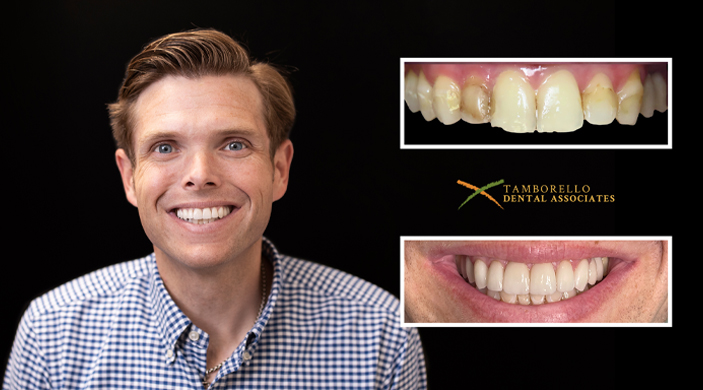 Man smiling next to images of his teeth before and after dentistry