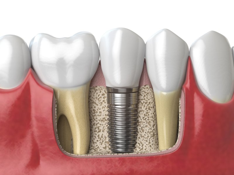 Illustration of dental implants in Montrose