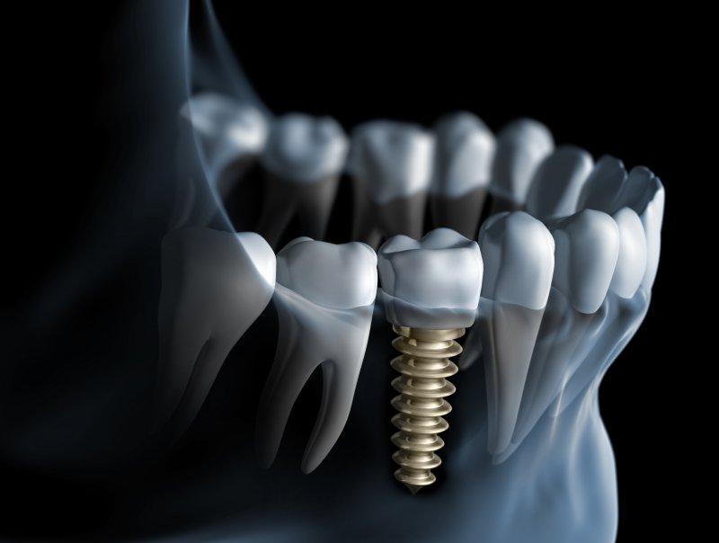 Dental implant digital illustration