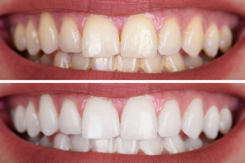 a before and after image of a person who recently had their teeth whitened