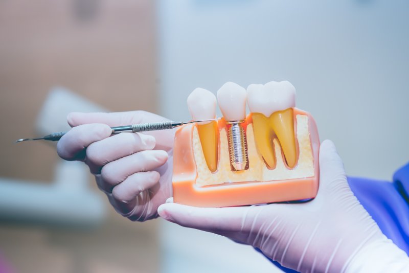 dentist explaining dental implant model